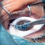  Patients wrong eye removed during operation in Slovakia