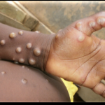  Bauchi Govt confirms first case of Monkey Pox